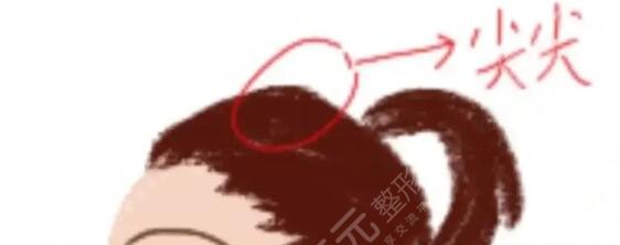 颅顶增高