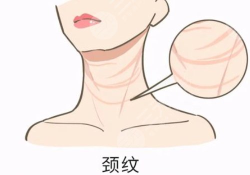 颈纹是什么原因造成的？