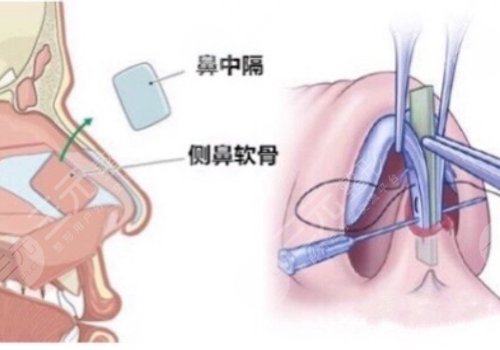 软骨隆鼻有什么后遗症？