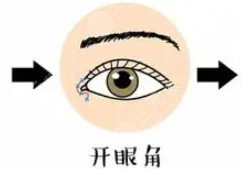 开眼角手术恢复期多久？