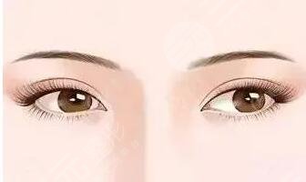 埋线双眼皮多久自然恢复正常？埋线双眼皮优势是什么？