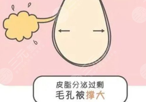 男性毛孔粗大油腻怎么改善？