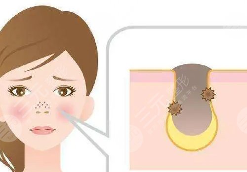 男性毛孔粗大油腻怎么改善？