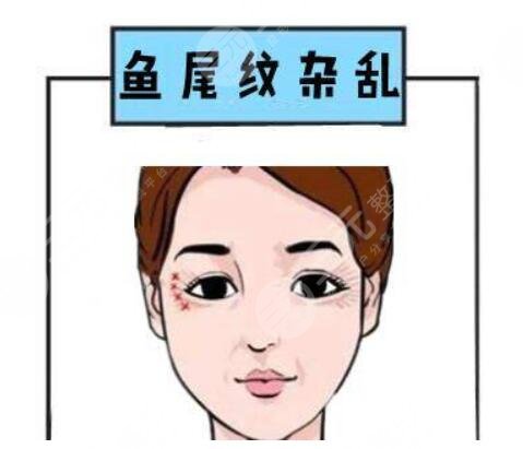 眼尾纹除皱哪种方法好?