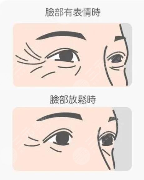 眼尾纹除皱哪种方法好?