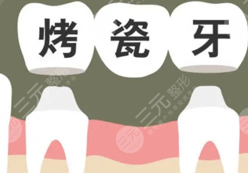 烤瓷牙多少钱一颗价格表2024