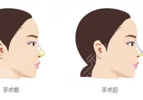 假体隆鼻整形费用大概多少？