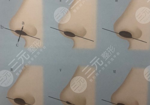 假体隆鼻整形费用大概多少？