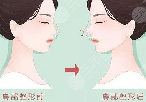 假体隆鼻整形费用大概多少？