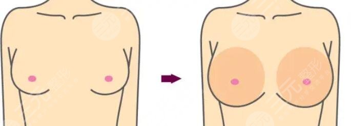 花样年华隆胸假体能终生不取吗?