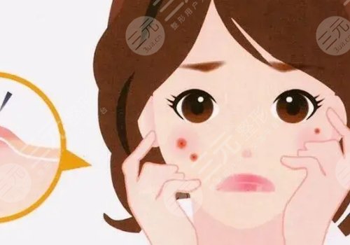 如何去除脸上的青春痘？