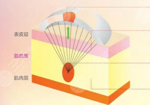 热玛吉四代全脸做一次多少钱？