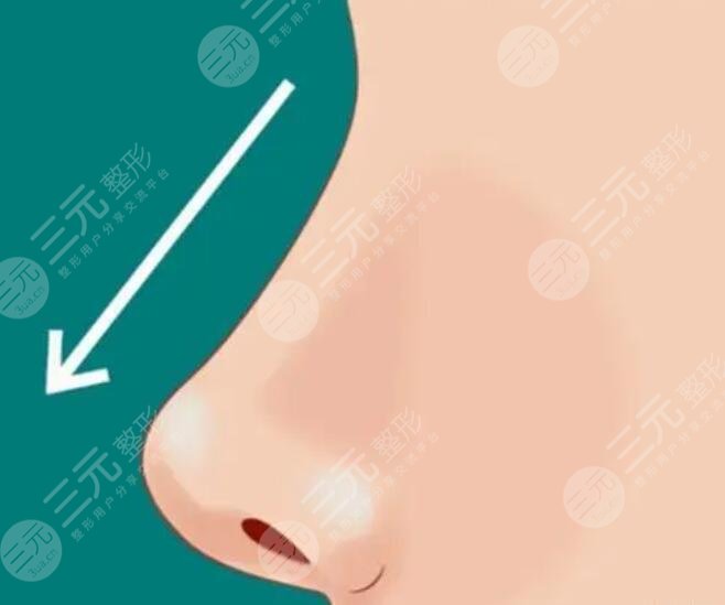 自体软骨隆鼻材料好吗？3大优势让网红明星趋之若鹜！