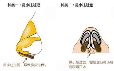 自体软骨隆鼻的风险