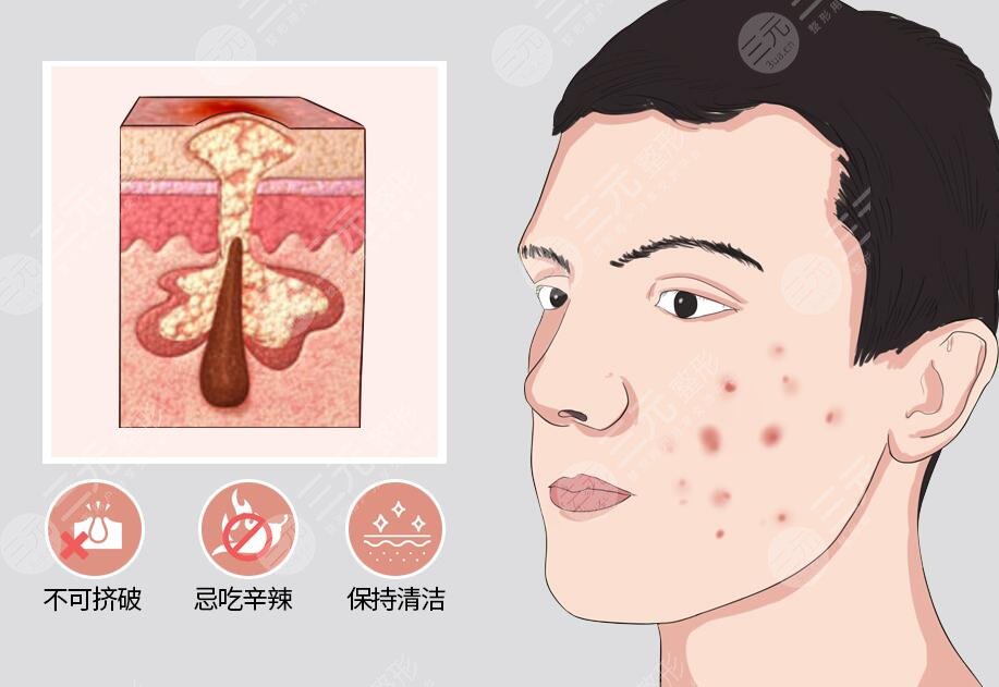 怎样才能去除青春痘?