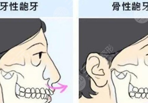 嘴凸怎么办？