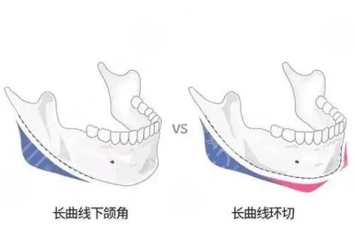 下颌角宽大怎么改善？