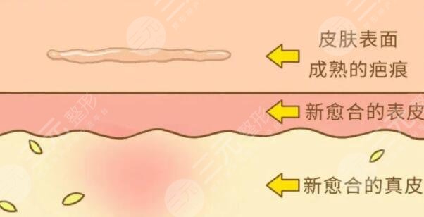 像素激光去疤痕要做多少次才会好?