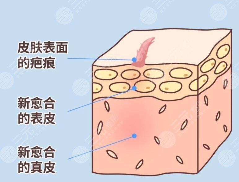 像素激光去疤术后注意事项