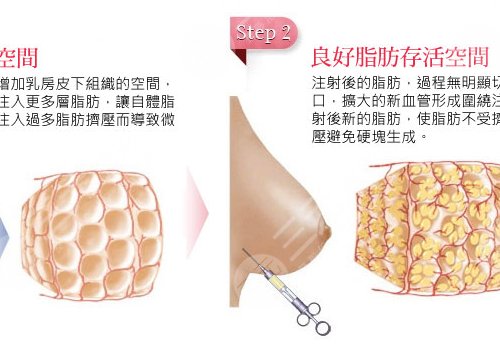 自体脂肪隆胸可以保持多少年？