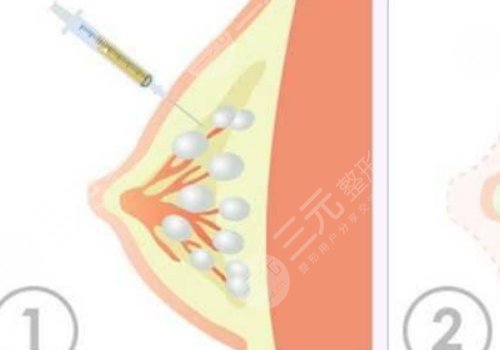 抽脂填充胸部多少钱？