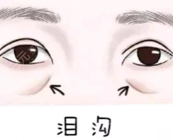 什么是泪沟?