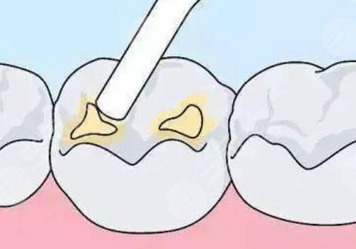 补牙材料有哪几种？