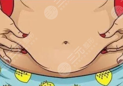 腹壁成型术术后多久能恢复