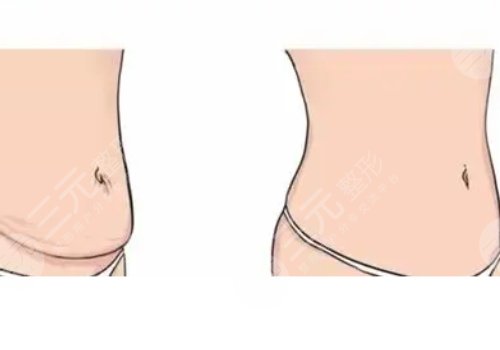 腹壁成型术术后多久能恢复