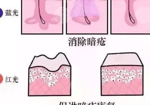 红光治疗痤疮能不能每天都照？