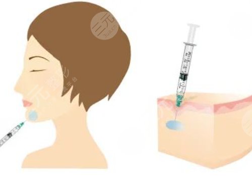 莫娜丽莎的玻尿酸可以填充哪里？