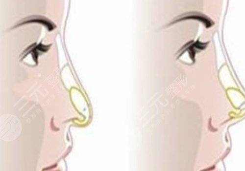妈生鼻和直鼻微翘的区别是什么？