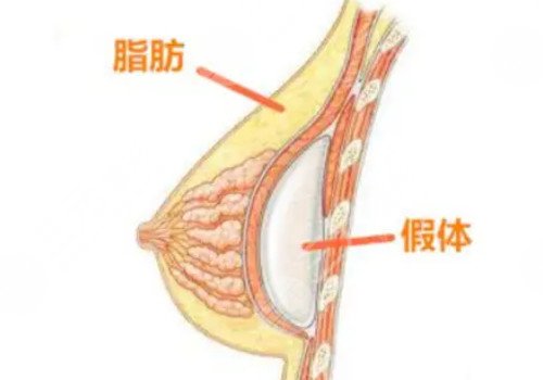 自体脂肪隆胸和假体隆胸哪个好?