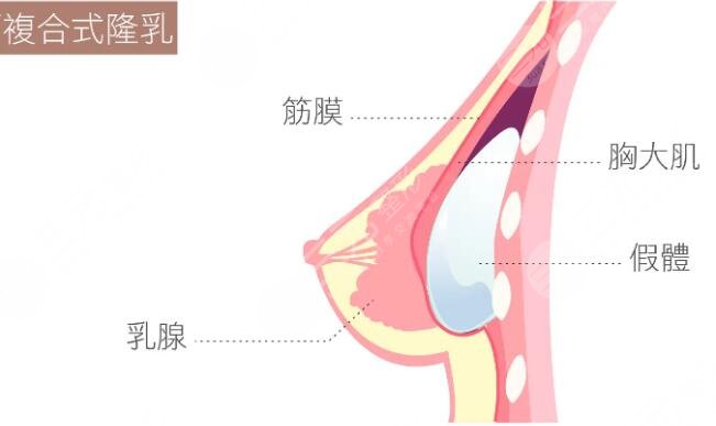 隆胸