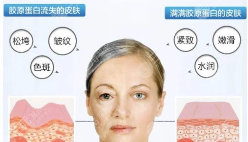 玻尿酸和胶原蛋白填充哪个效果好？