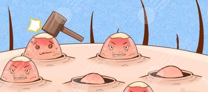 激光祛痘
