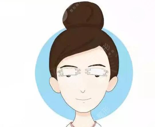 双眼皮后遗症预防和治疗方法