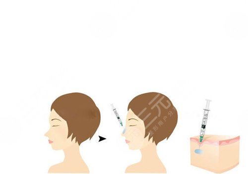 宝尼达玻尿酸隆鼻可以维持多久？