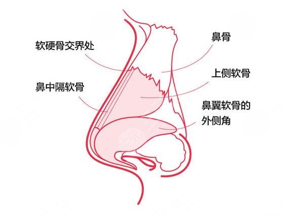 玻尿酸隆鼻的注意事项