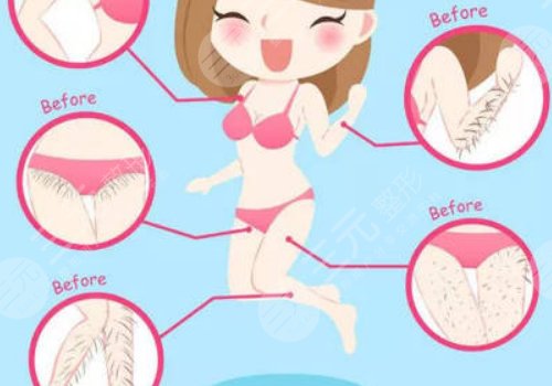 激光脱毛有副作用吗