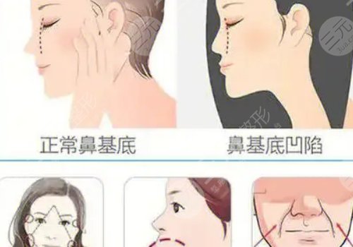 珊瑚骨填充鼻基底安全吗