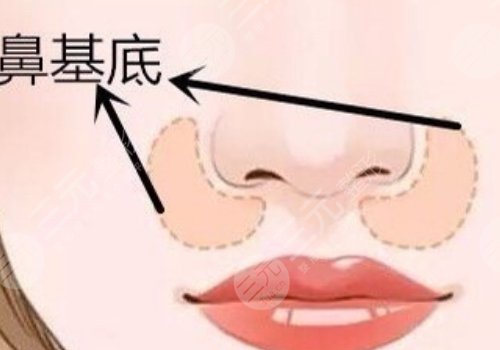 珊瑚骨填充鼻基底的价格