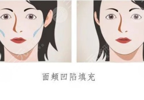 面颊凹陷填充胶原蛋白好还是玻尿酸好？