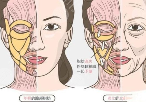 面颊凹陷填充胶原蛋白好还是玻尿酸好？