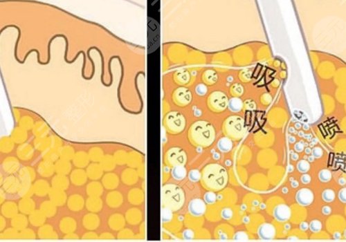 自体脂肪面部填充的副作用和危害