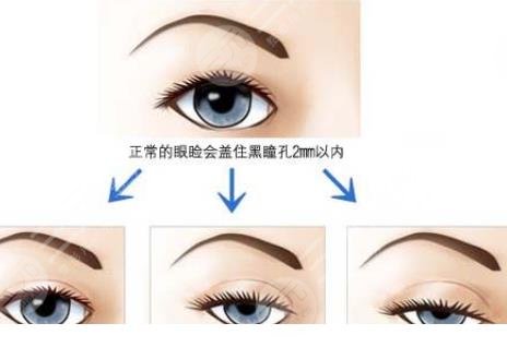 眼睑下垂
