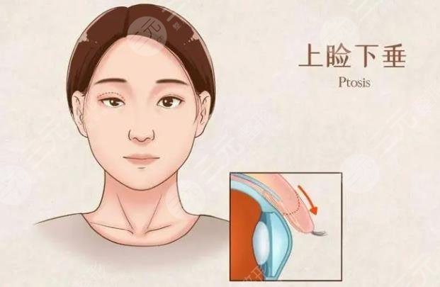 眼睑下垂