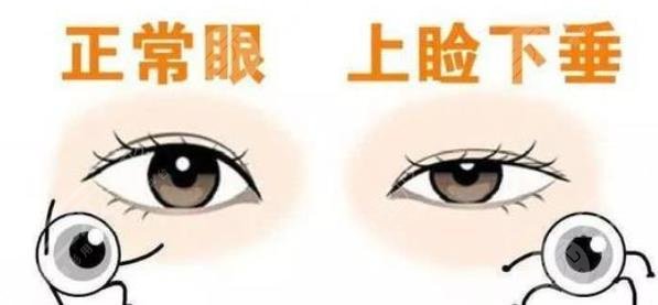 眼睑下垂