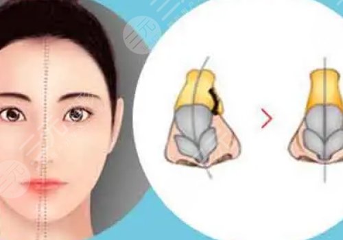 珊瑚骨填充有什么弊端？