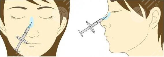 玻尿酸隆鼻怎么样？玻尿酸隆鼻的优势及保养注意事项讲明！